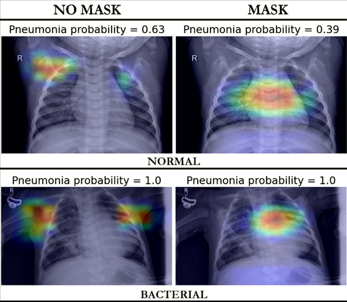 Attention heatmaps comparing model focus with and without thoracic masking